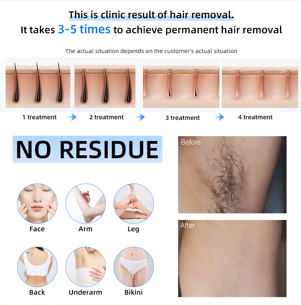 Cena fabryczna 20000000   Beat – Industrial Laser Hair Removal Machine recenzja i cena